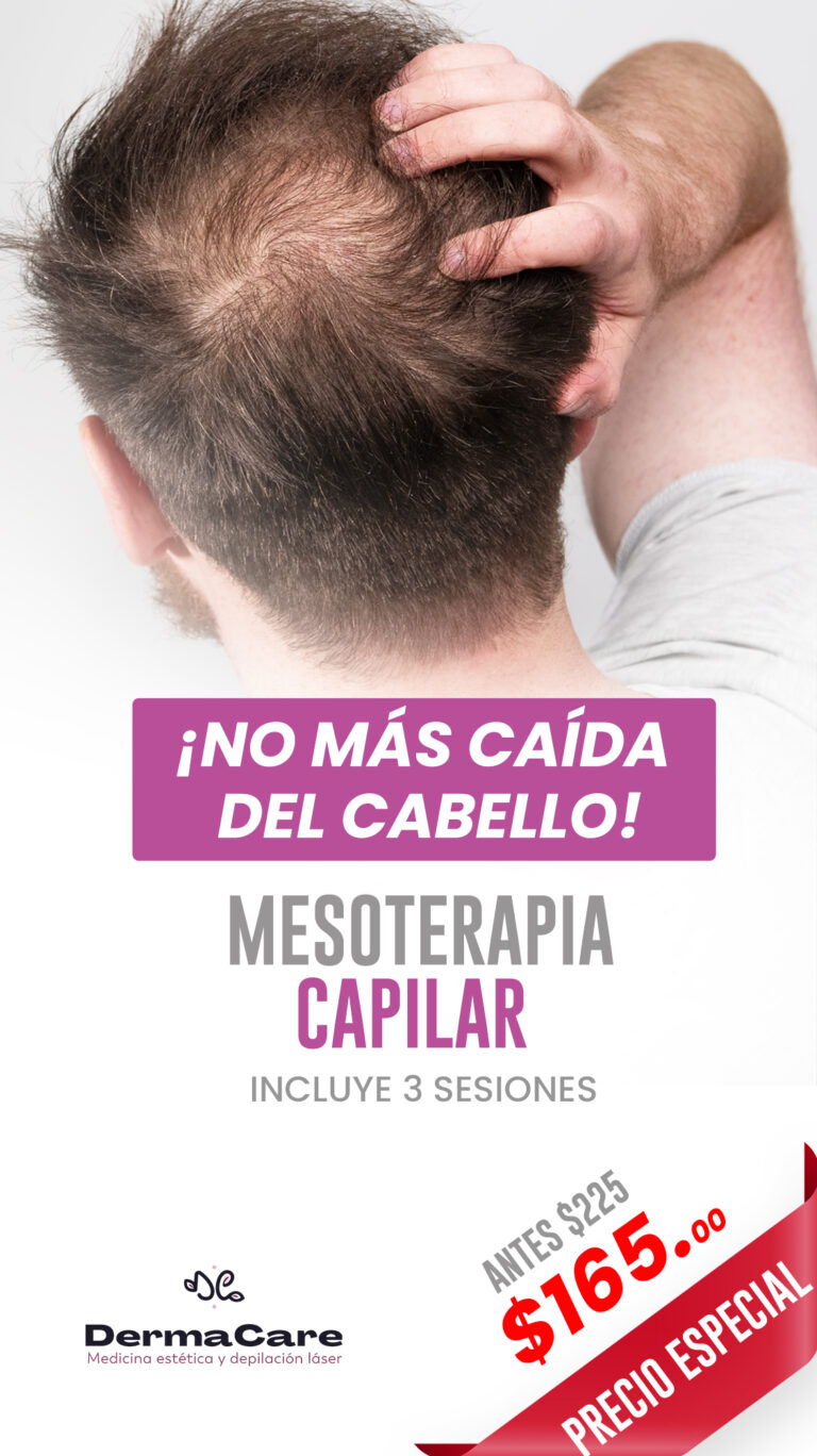 mesoterapia-capilar-hombre.historia